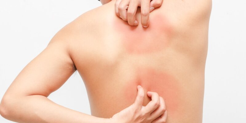 psoriasis treatment guidelines