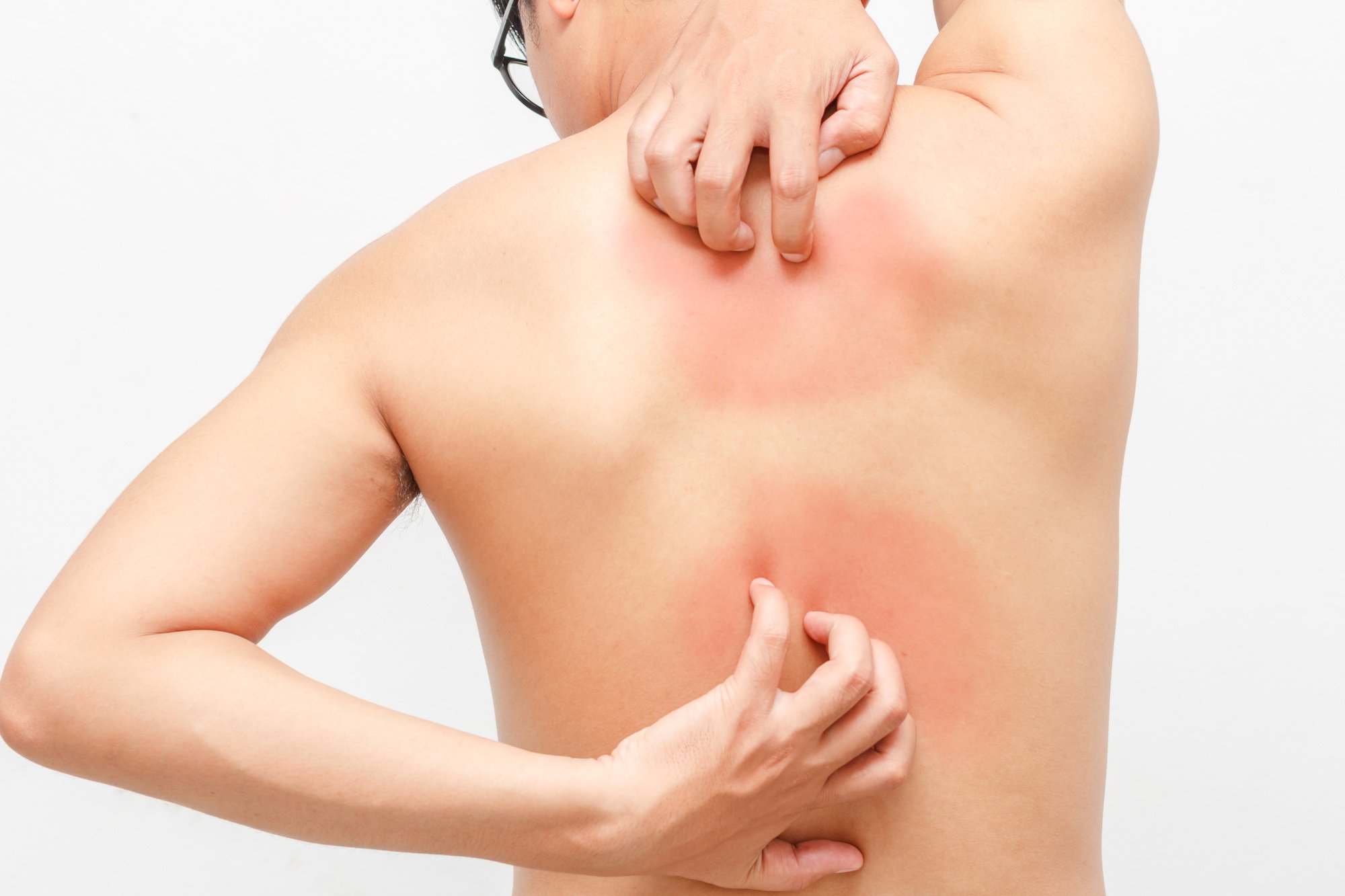 psoriasis treatment guidelines